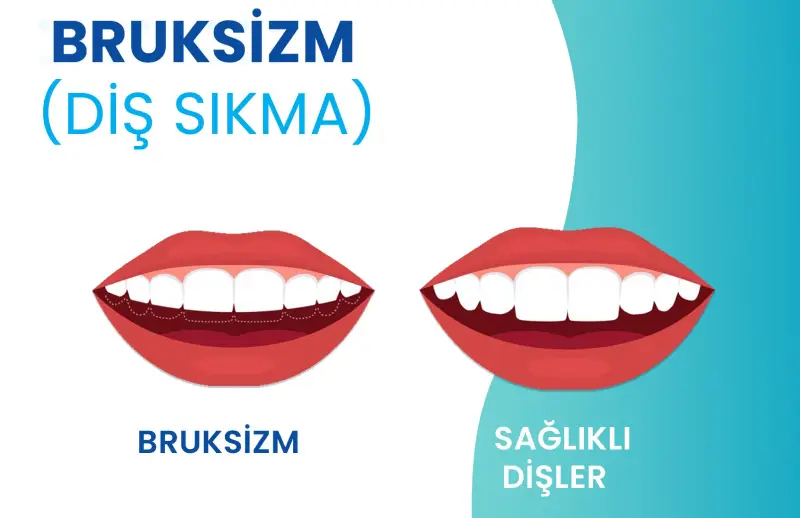 Bruksizm (diş sıkma) nedeniyle çene ağrısı yaşayan ve elini çenesine götüren kişi
