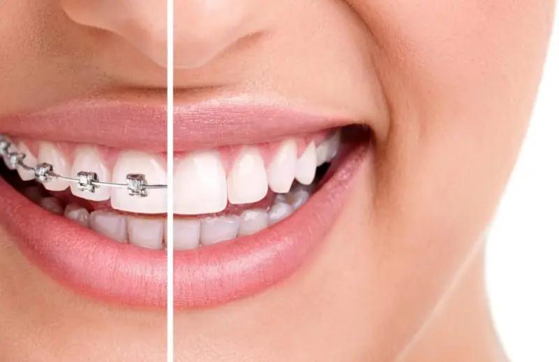 Metal braketli diş teli takılı dişlerin yakından görünümü