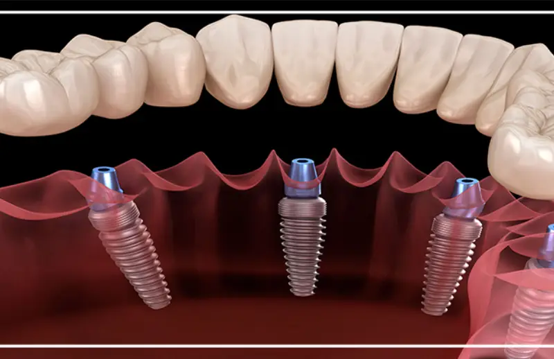 İmplant destekli sabit protez — çene modeli üzerinde implantlara sabitlenen protez dişler