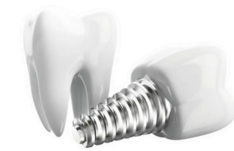Diş implantı modeli — çene kemiğine yerleştirilen titanyum implant vidası ve üzerine takılan kron