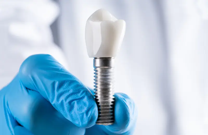 Diş implantının çene kemiğine yerleştirilme aşamalarını gösteren implant modeli