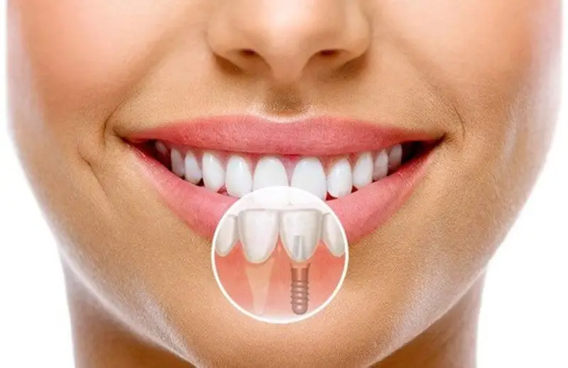 İmplant tedavisi sonrası bakım — çene modelinde diş implantı vidasının yerleşimi