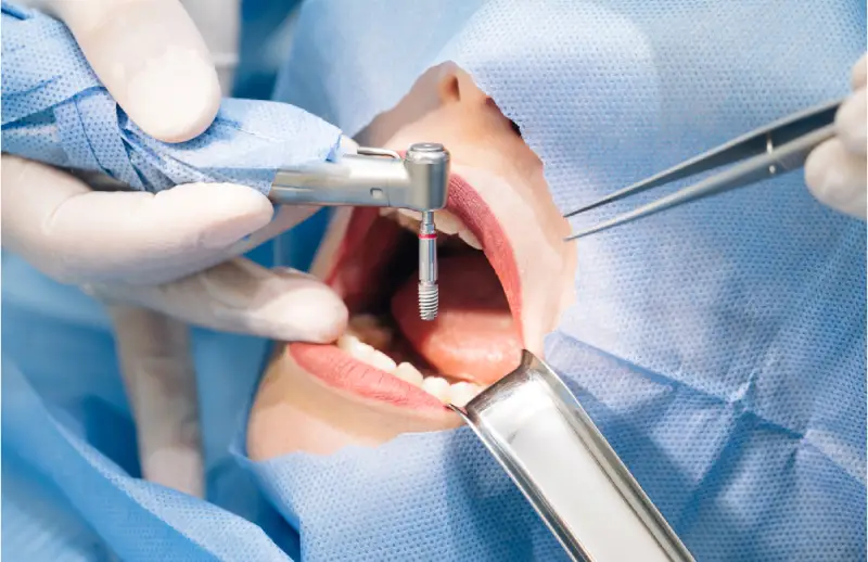 Titanyum dental implant ve kuron modeli — çene kemiğine yerleştirilmiş implant maketi