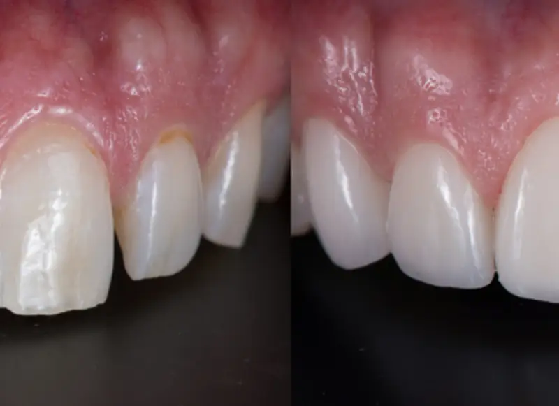 Lamine veneer — diş yüzeyine uygulanan ince yaprak porselen kaplama örneği