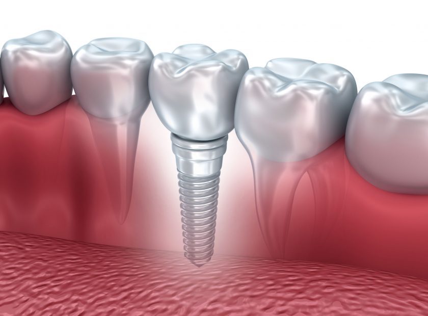 50149095 - tooth human implant, 3d illustration
